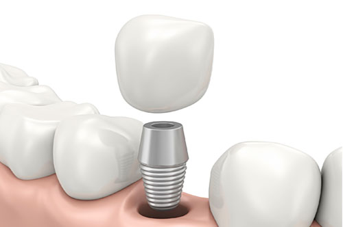 Discover The Blessings Of Dental Implants