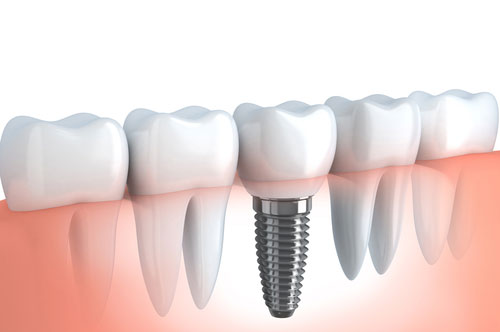Are Dental Implants The Right Solutions For You? [QUIZ]