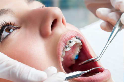 Fix Slightly Crooked Teeth With Short-Term Orthodontics [VIDEO]